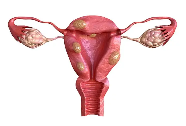 Fibroids Treatment